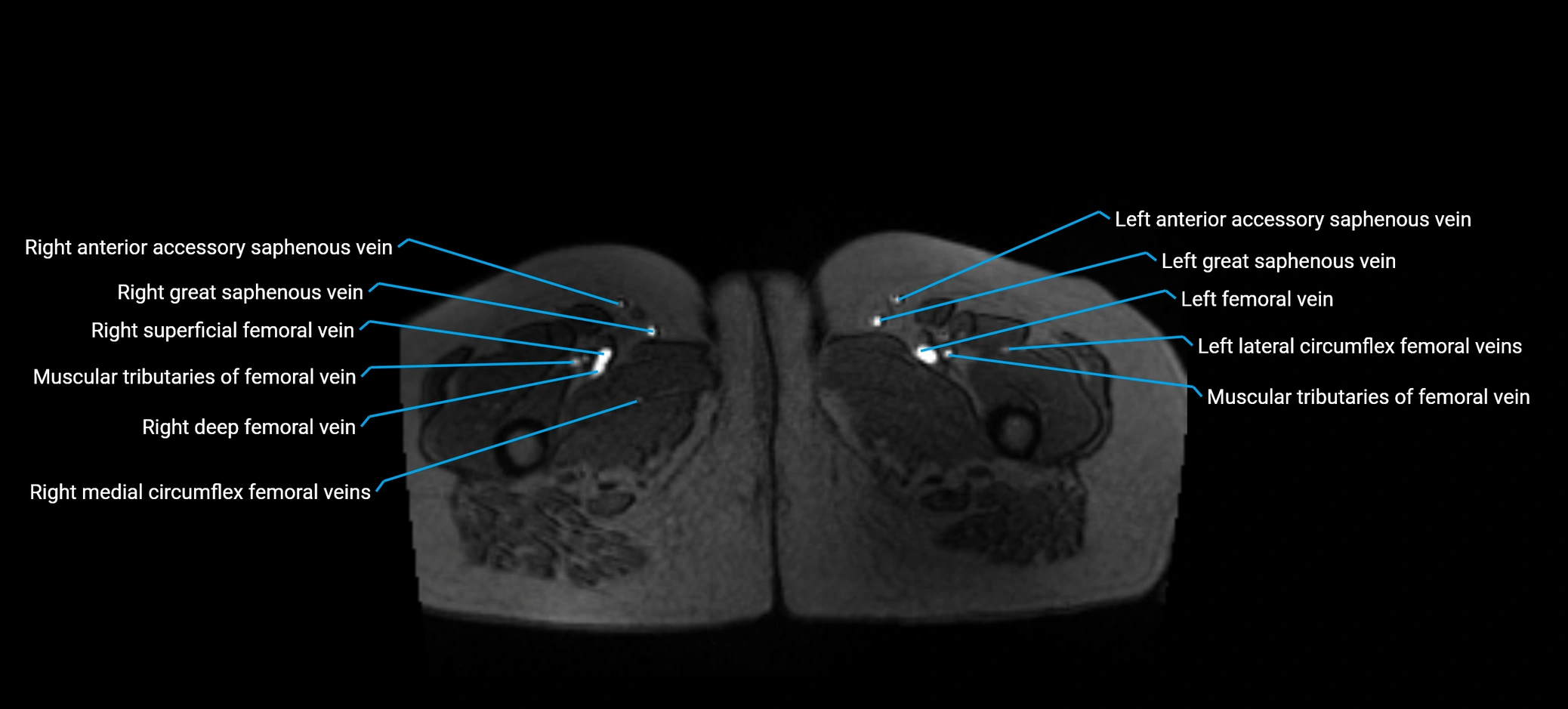 MRV abdomen pelvis & lower limb axial cross sectional anatomy labelled MRI image 212 (1).webp